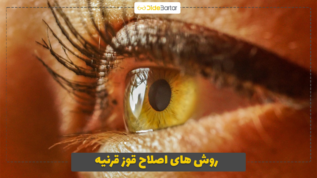 روش های اصلاح قوز قرنیه