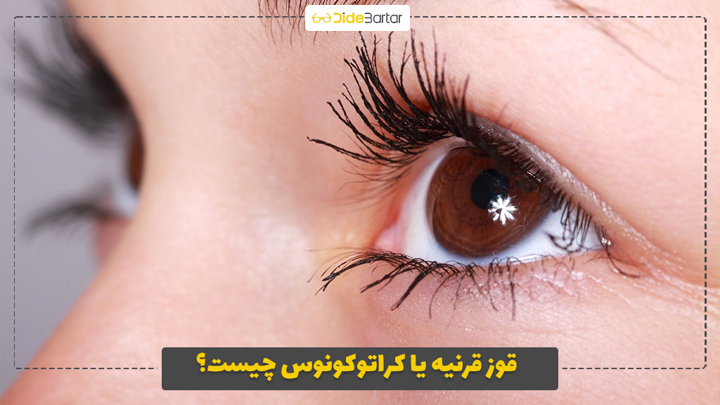 قوز قرنیه یا کراتوکونوس چیست؟