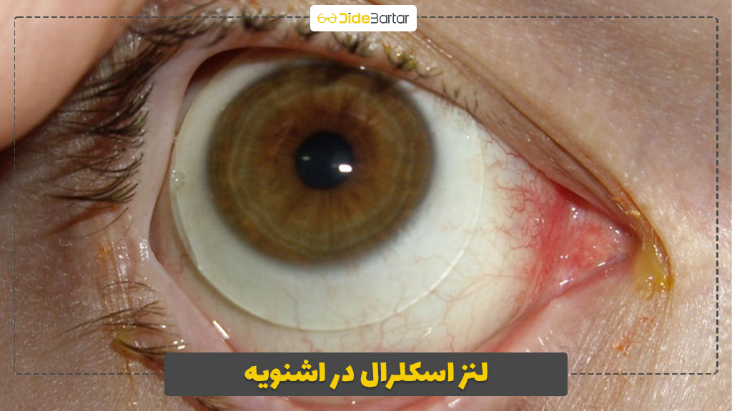 لنز اسکلرال در اشنویه