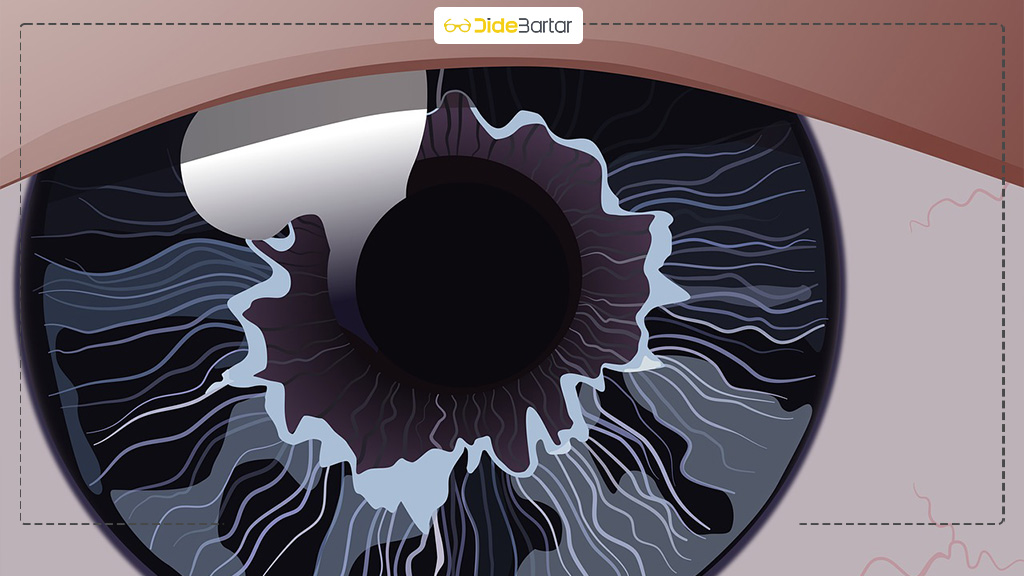 نحوه گذاشتن لنز اسکلرال در چشم
