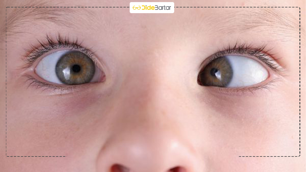 ارتباط تنبلی چشم با مشکلات بینایی دیگر