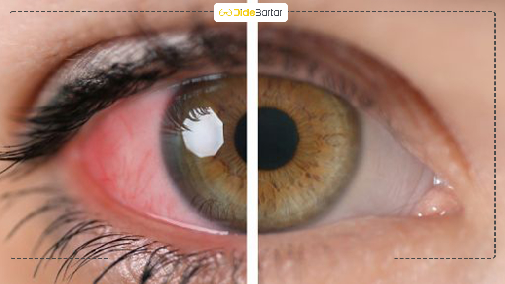 آیا آب سیاه باعث نابینایی می‌ شود؟