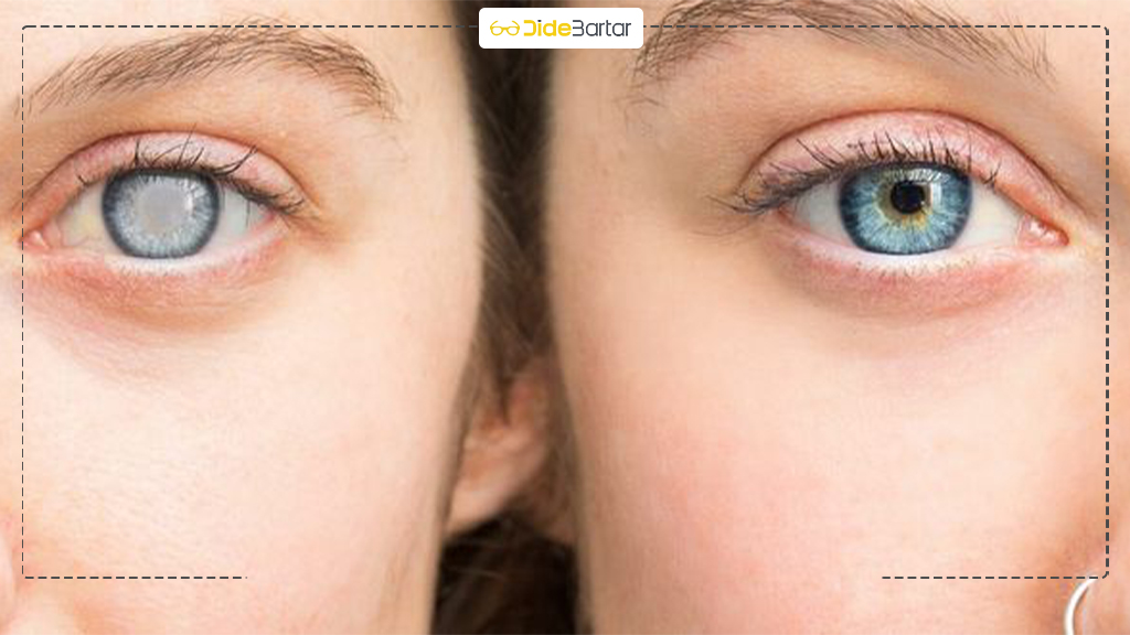 آیا آب سیاه باعث نابینایی می‌ شود؟