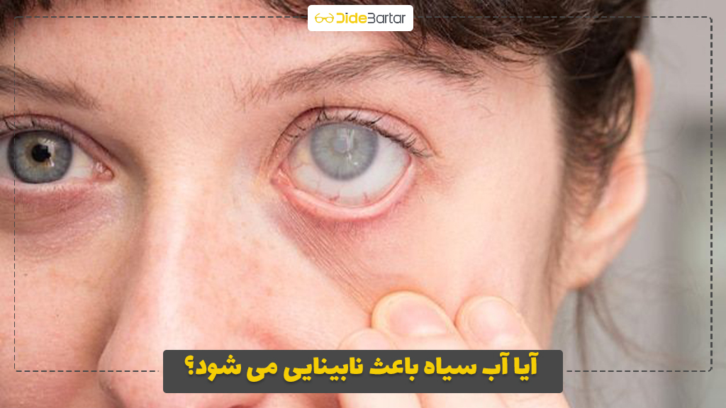 آیا آب سیاه باعث نابینایی می‌ شود؟