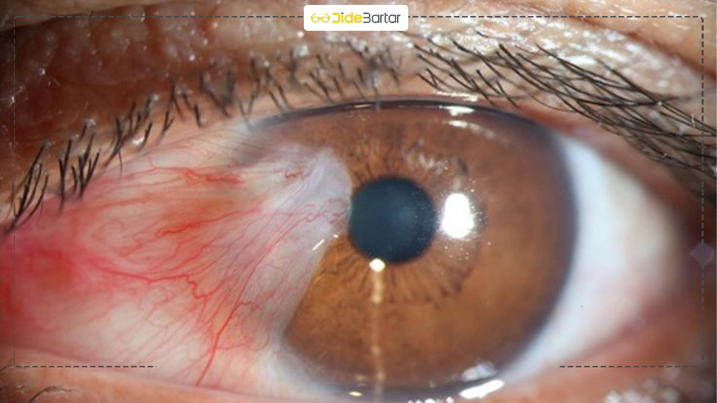 تأثیر اشعه UV بر چشم و راه‌ های محافظت