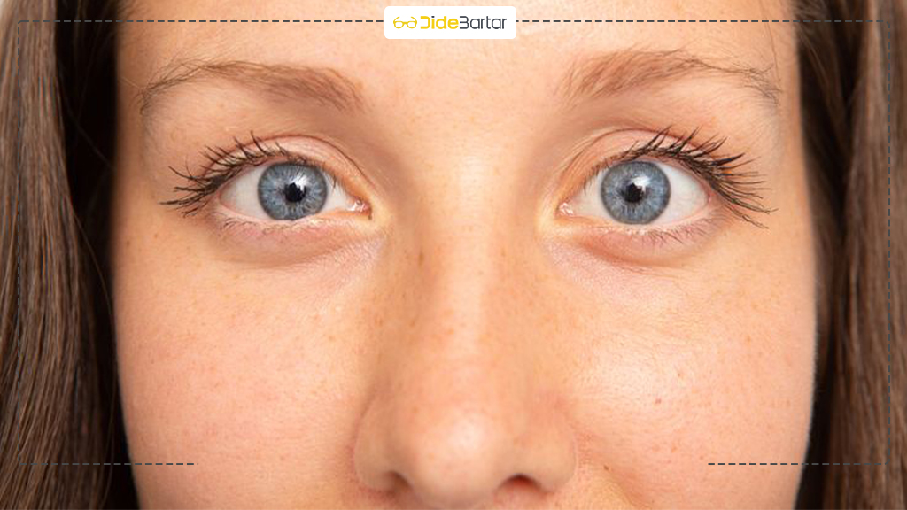 فرق استرابیسم با تنبلی چشم