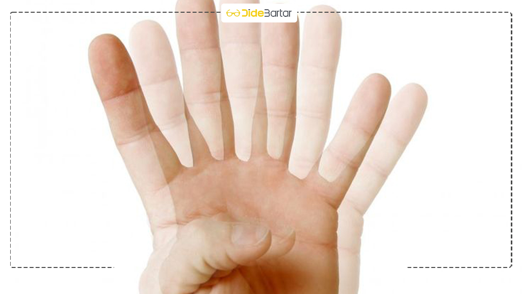 فرق استرابیسم با تنبلی چشم