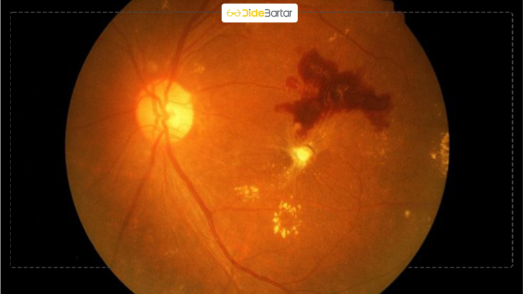 ارتباط دیابت با بیماری‌ های چشمی