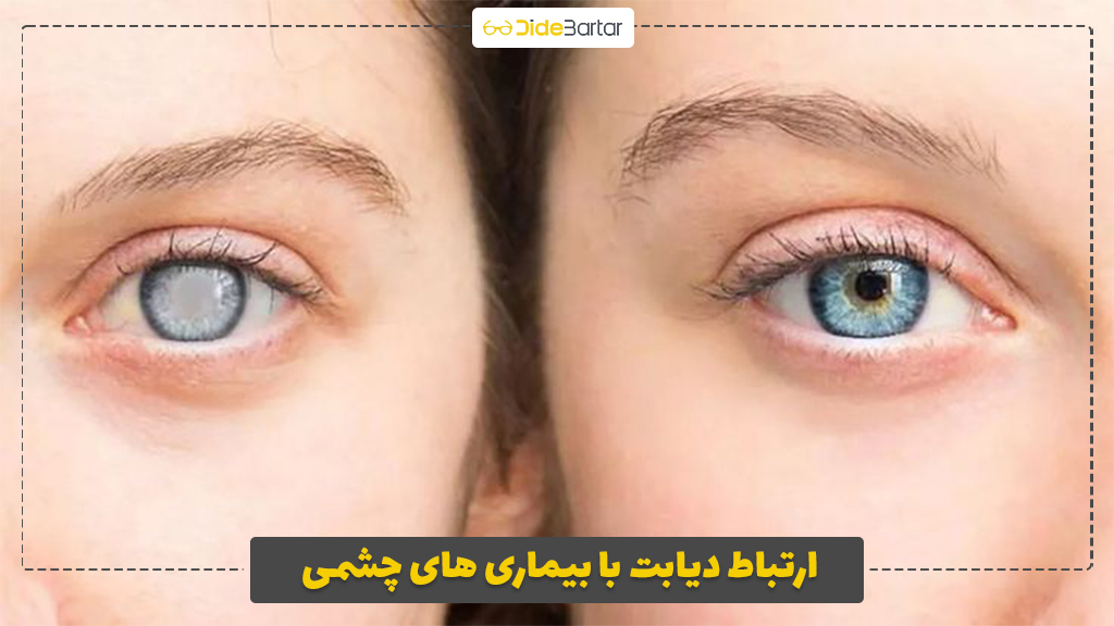 ارتباط دیابت با بیماری‌ های چشمی