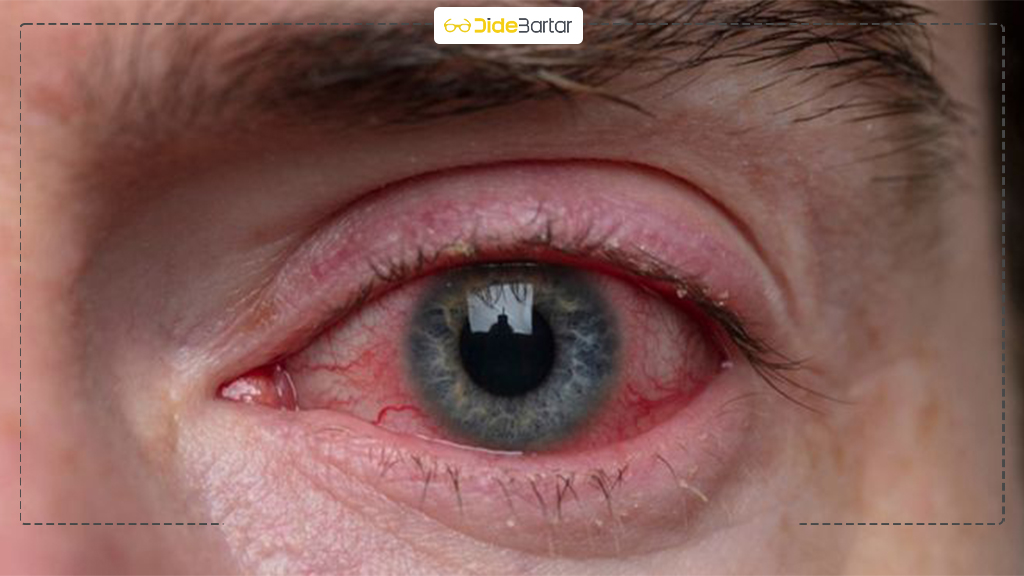 تفاوت کوررنگی مادرزادی و اکتسابی: کدام قابل درمان است؟