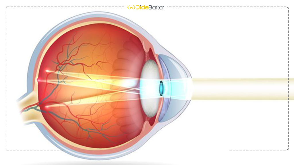 آیا کودکان هم دچار دوربینی می‌ شوند؟