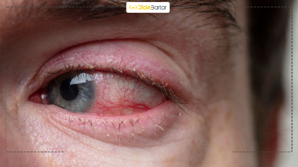 التهاب ملتحمه چیست؟