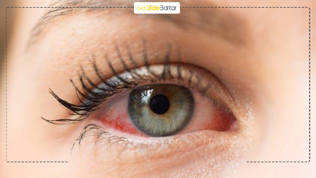 التهاب ملتحمه چیست؟