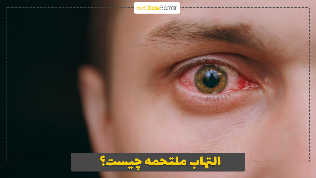 التهاب ملتحمه چیست؟