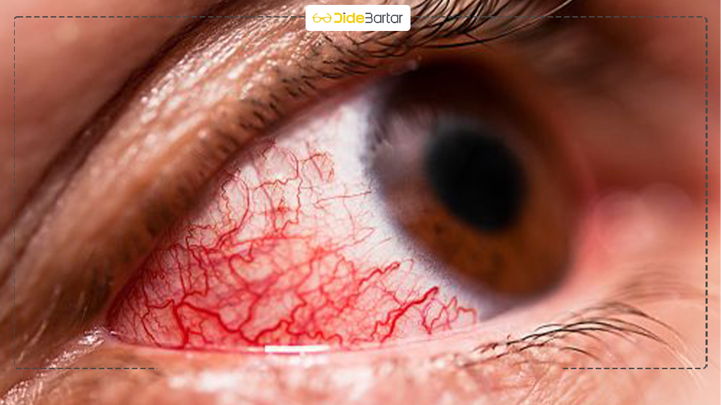 تفاوت التهاب ملتحمه با ناخنک چشم