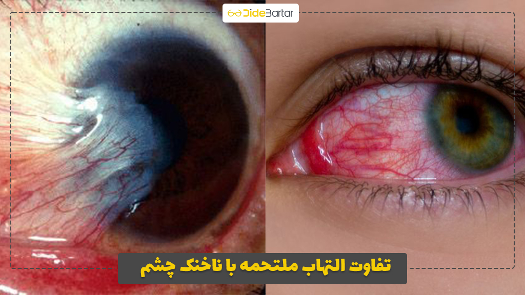تفاوت التهاب ملتحمه با ناخنک چشم