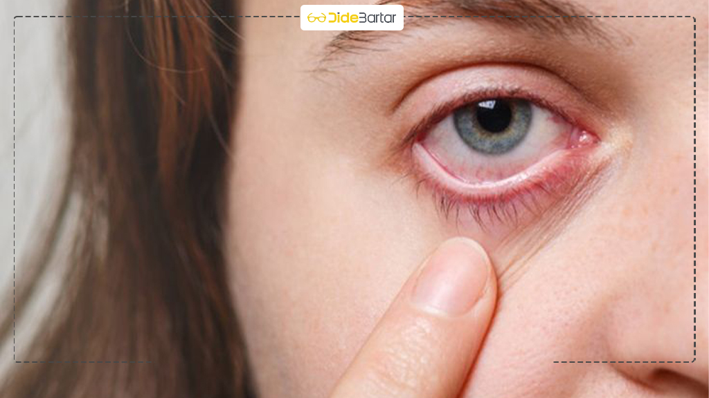 علت تاری دید ناگهانی در بزرگسالی