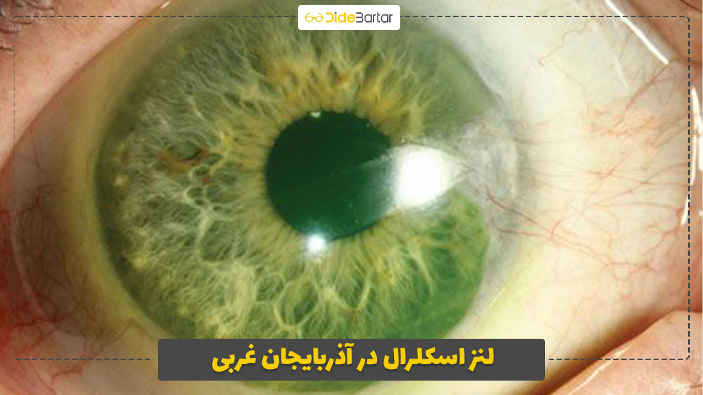 لنز اسکلرال در آذربایجان غربی