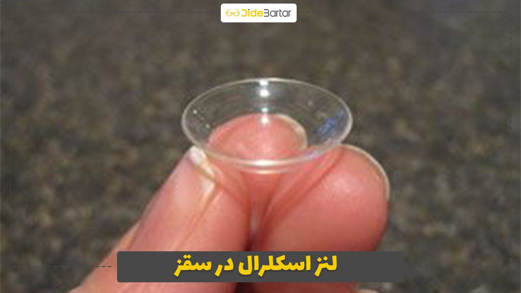 لنز اسکلرال در سقز