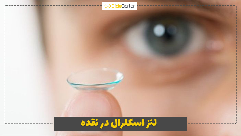 لنز اسکلرال در نقده