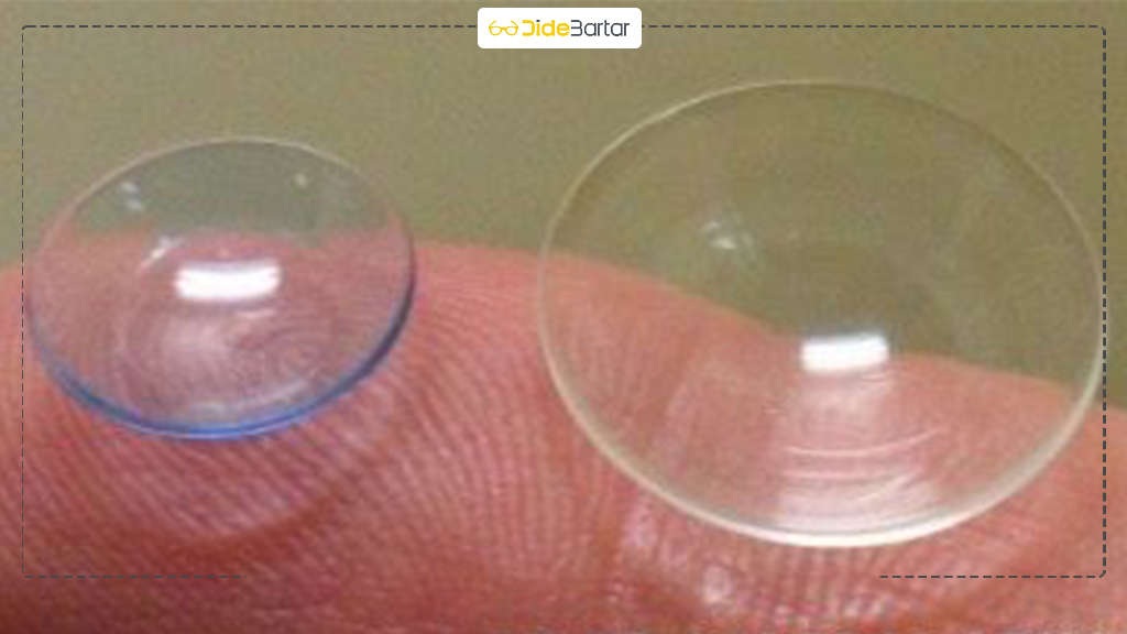 لنز اسکلرال در نقده