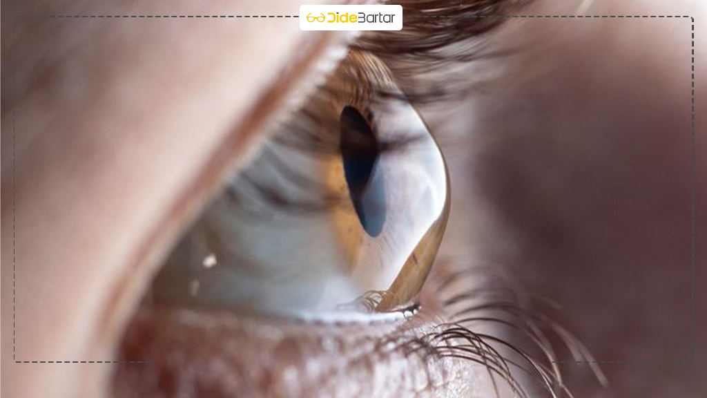 لنز اسکلرال در نقده